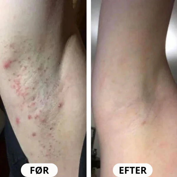 IPL PRO Advanced Hårfjerner - HPLE Teknologi - 17 J/cm² Effekt