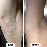 IPL PRO Advanced Hårfjerner - HPLE Teknologi - 17 J/cm² Effekt