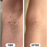 IPL PRO Advanced Hårfjerner - HPLE Teknologi - 17 J/cm² Effekt