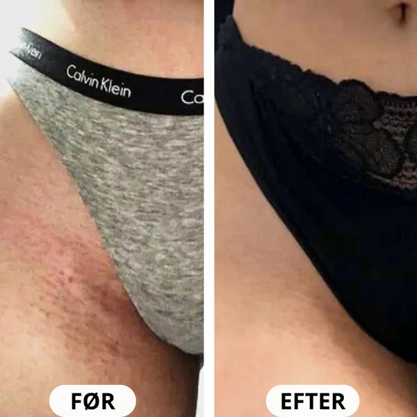 IPL PRO Advanced Hårfjerner - HPLE Teknologi - 17 J/cm² Effekt